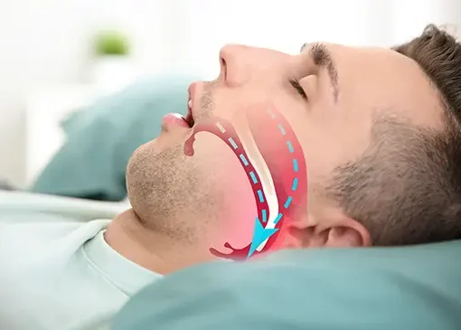 Man asleep wearing an oral appliance that keeps his airway open