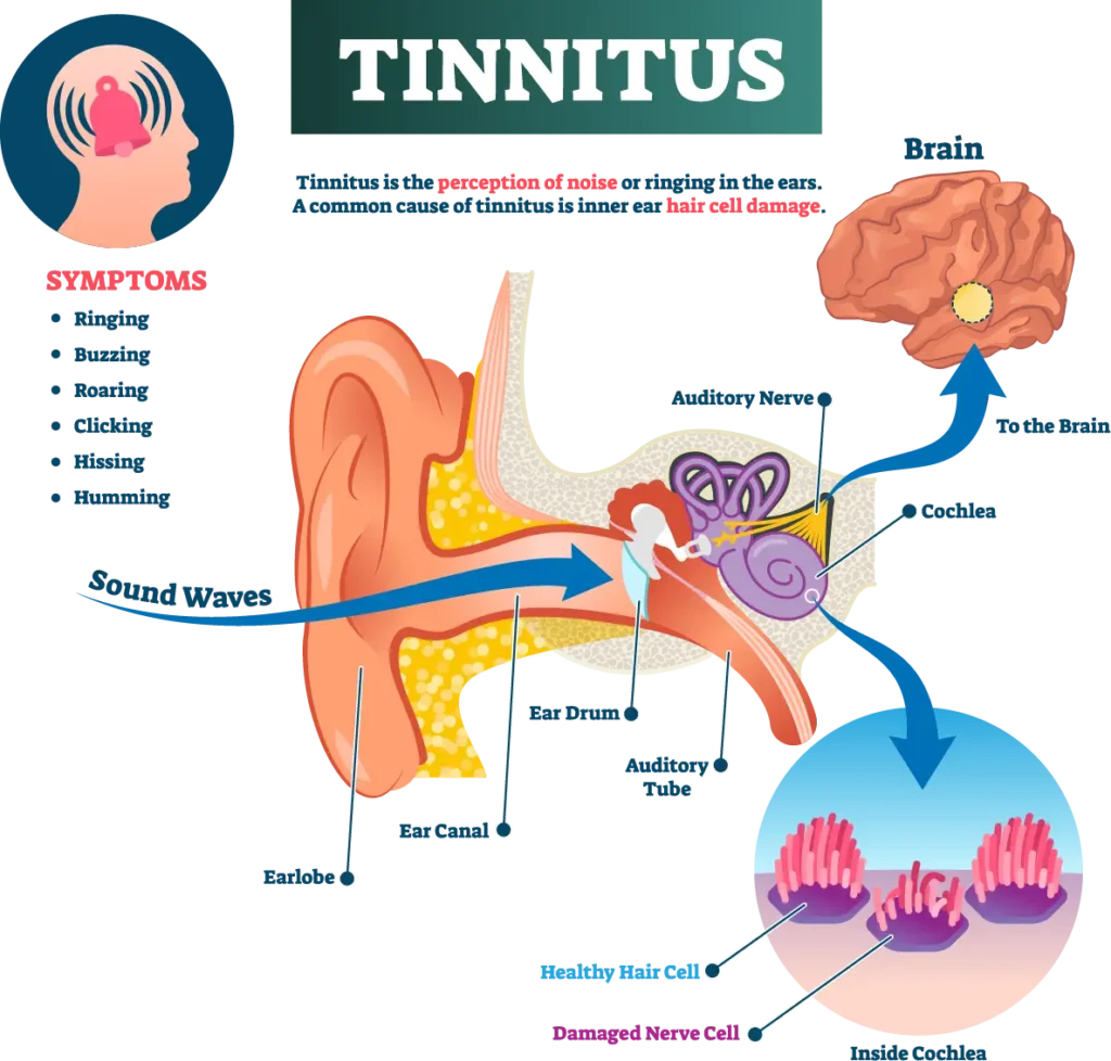 Tinnitus