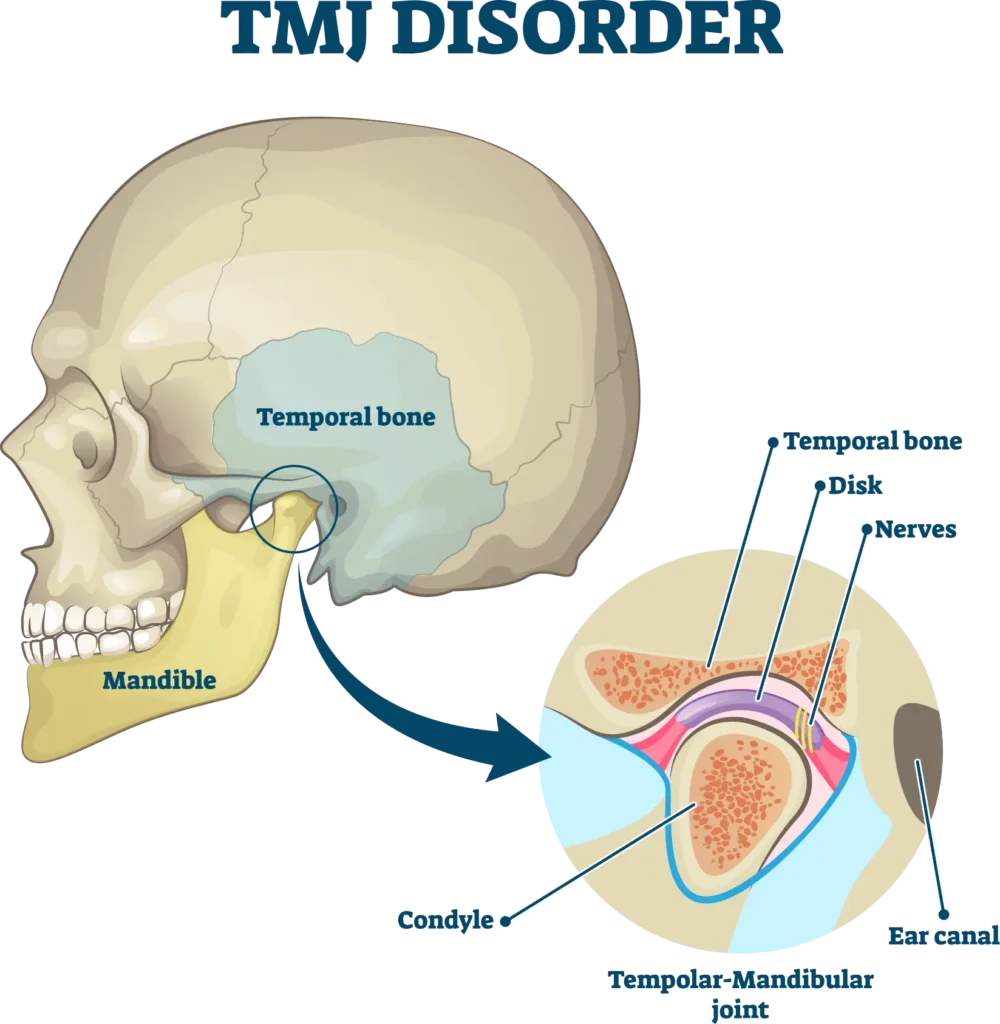 TMJ Infographic