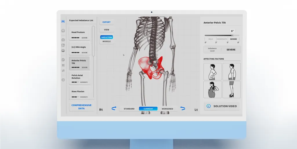 Moti Physio software showing a 3D skeleton with highlighted pelvis and postural measurements