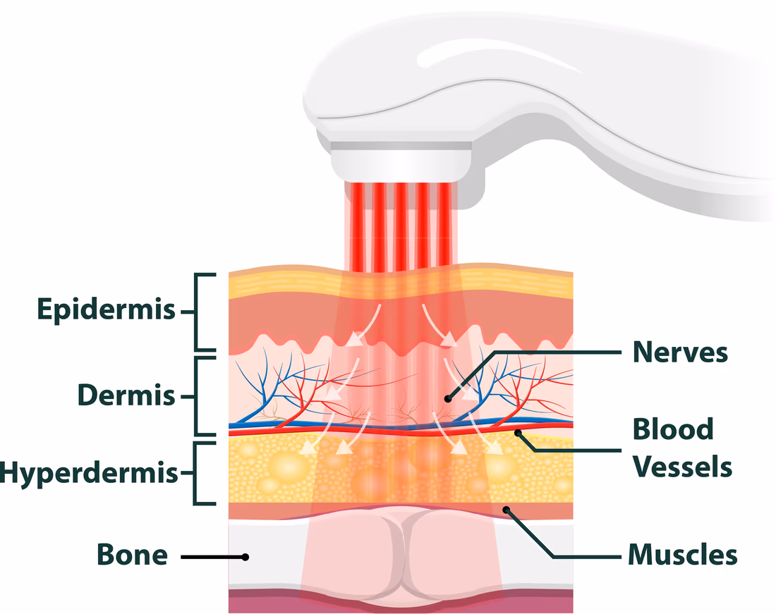 How deep tissue laser therapy reaches inflamed tissue Cross-section diagram of a deep tissue laser handpiece sending red light through the epidermis, dermis and hyperdermis to reach nerves, blood vessels, muscle and bone