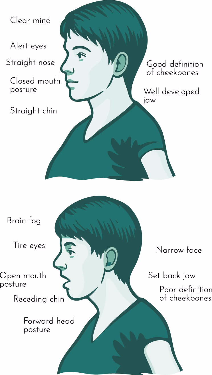 Healthy versus poor oral posture Side-by-side illustration comparing healthy oral posture — closed lips, well developed jaw, straight chin — with poor oral posture showing an open mouth, receding chin and forward head posture