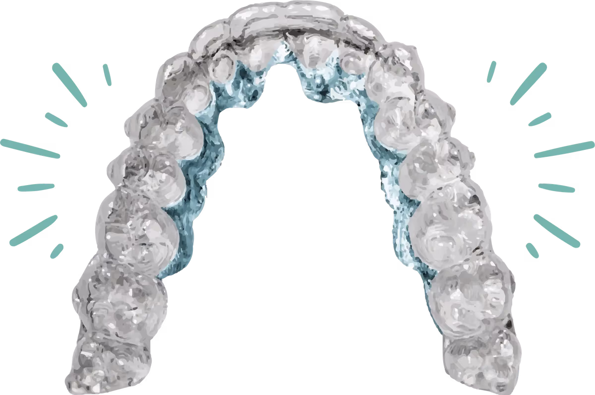Nuvola clear aligner tray Illustration of a clear orthodontic aligner tray shaped to the upper dental arch