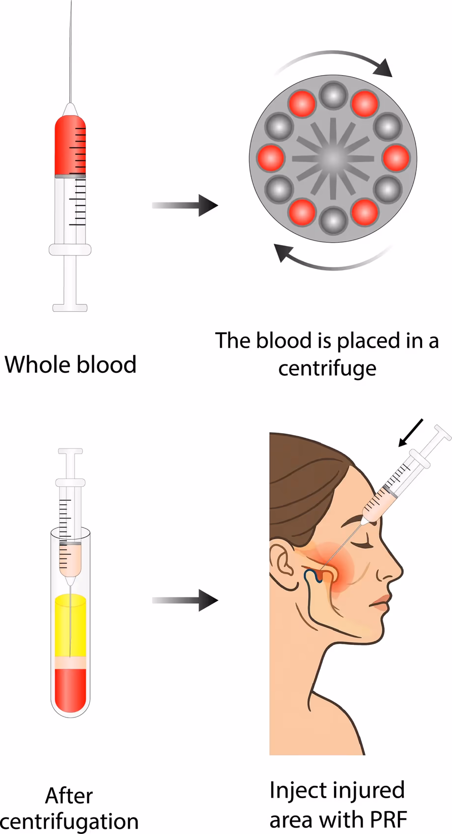 How PRF injections are prepared and delivered Four-step diagram of the PRF process: whole blood drawn into a syringe, spun in a centrifuge, the separated platelet-rich fibrin layer, then injected into the jaw joint