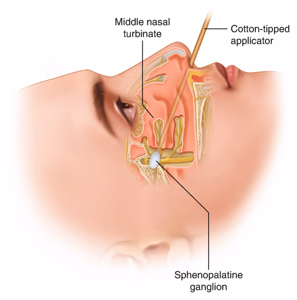 Sphenopalatine ganglion anatomy Labeled cross-section of the nose and face showing the sphenopalatine ganglion behind the middle nasal turbinate