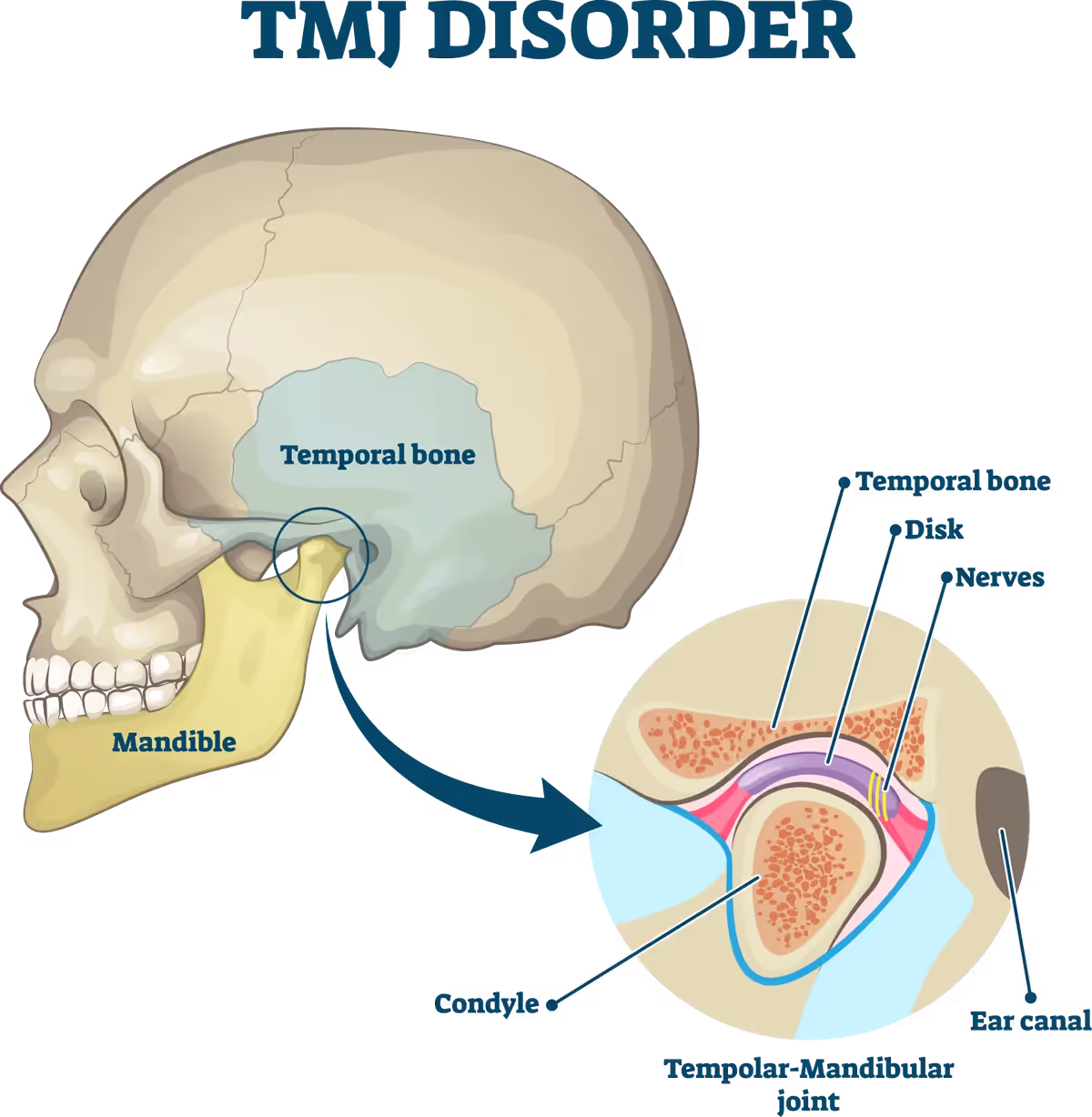 Anatomical diagram of the temporomandibular joint showing the mandible, temporal bone, articular disc, condyle and surrounding nerves