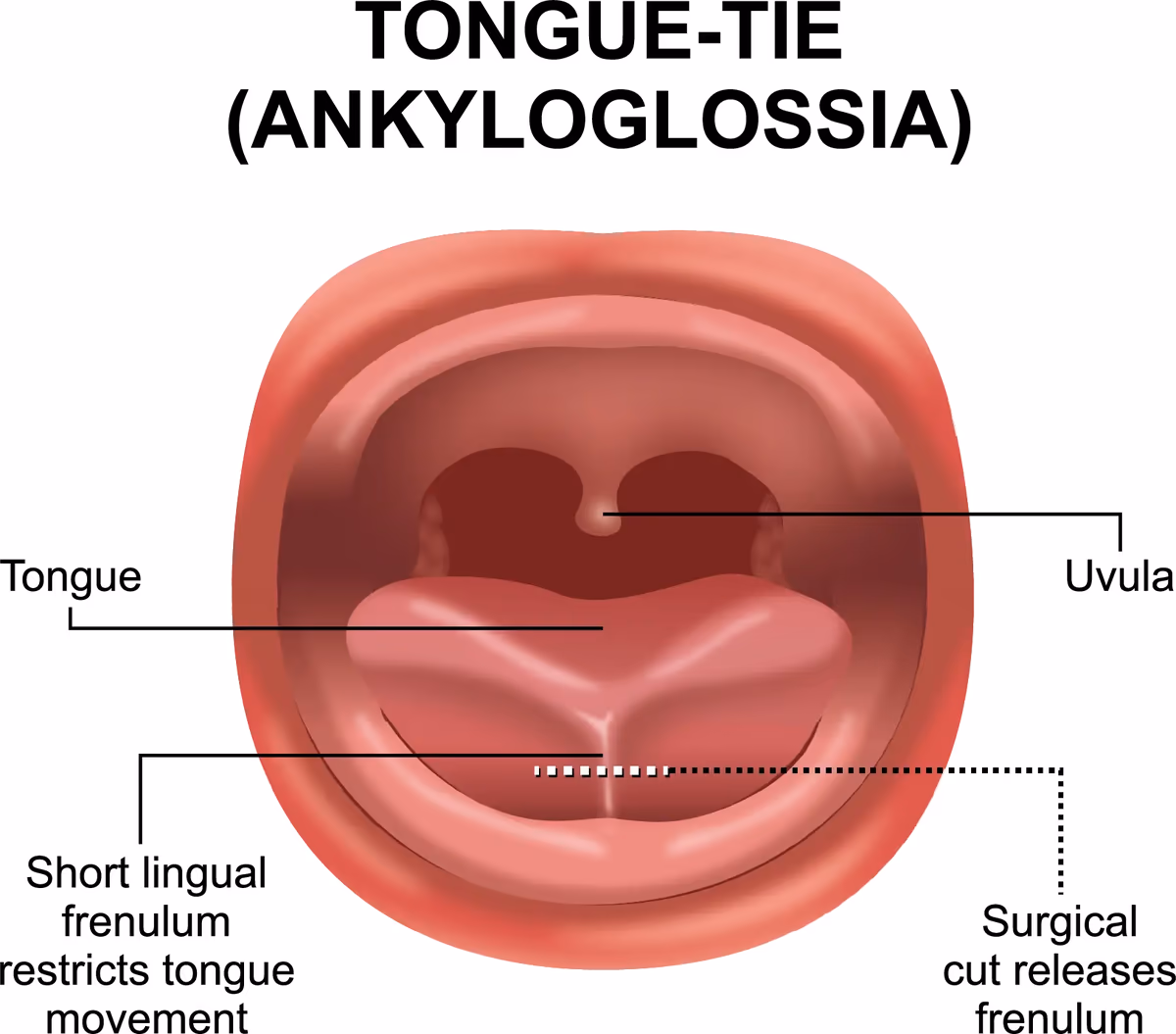 Tongue tie (ankyloglossia) anatomy Diagram of tongue tie (ankyloglossia) inside an open mouth, showing a short lingual frenulum restricting tongue movement and where a release frees it