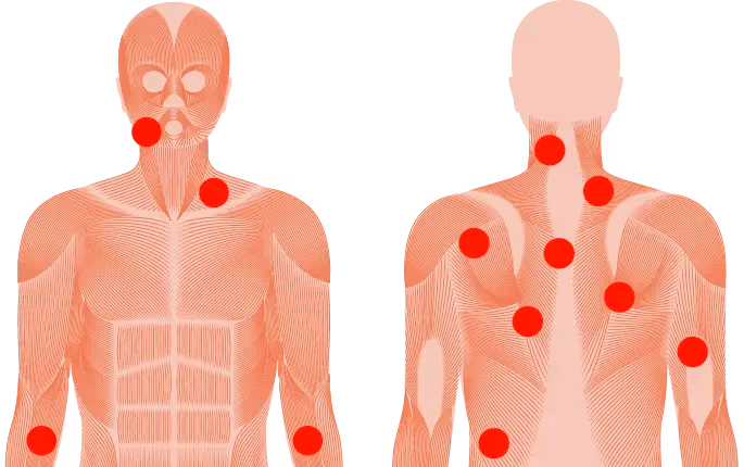 Where jaw, neck and shoulder trigger points form Front and back anatomical diagram marking common myofascial trigger point locations in the jaw, the front and back of the neck, the upper shoulders and the upper back